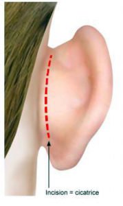 Cicatrice Chirurgie des oreilles décollées ou otoplastie à Paris - Dr Ozil schéma