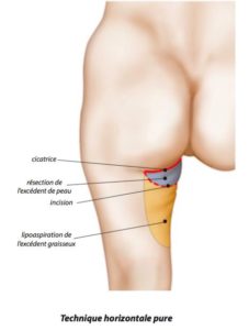 Cicatrices Lifting des cuisses à Paris - Dr Ozil