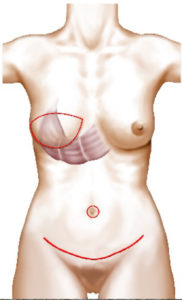 Reconstruction mammaire par DIEP à Paris - Dr Ozil