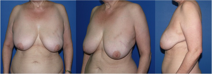 Reconstruction mammaire par DIEP à Paris - Avant / après - Dr Ozil