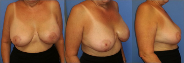 Reconstruction mammaire par DIEP à Paris - Avant / après - Dr Ozil