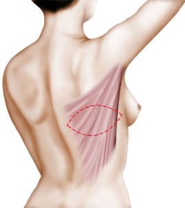 Reconstruction mammaire par lambeau de grand dorsal à Paris - Dr Ozil