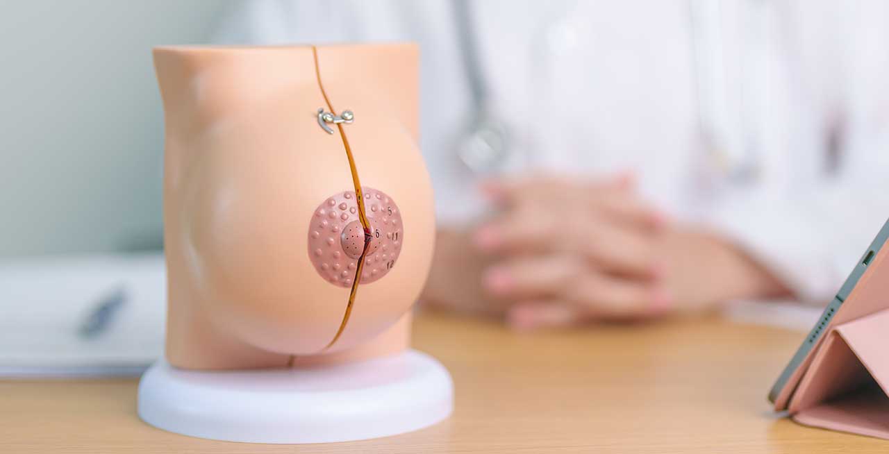 Les drains après une chirurgie du sein à Paris