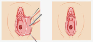 nymphoplastie longitudinale à Paris